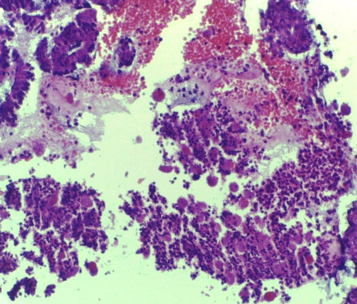 File:Amoebiasis of intestine, 20x.jpg