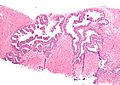 Neoplasia intraepiteliale prostatica di alto grado (PIN), colorazione con ematossilina-eosina, basso ingrandimento.