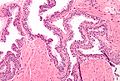 Neoplasia intraepiteliale prostatica di alto grado (PIN), colorazione con ematossilina-eosina, ingrandimento intermedio.