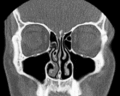 Nasal conchae: Blocked/free