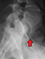 Spondylolisthesis L5/S1