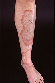 Large, well demarcated plaques with red, active borders, all located on the lower leg of an adult