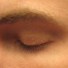 Close-up view of an adult eyelid on which there are numerous small, elevated skin lesions filled with white material