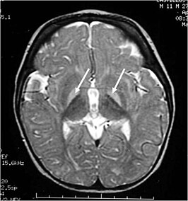 MRI van de hersenen. Hyperintense laesies van de basale kernen op T2-gewogen afbeeldingen.