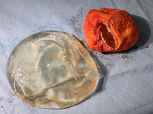 Removed Breast Implant & Capsular Contracture Scar Tissue