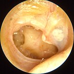 kronisk öroninflammation (mesotympanalis)