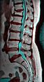 MRI of L5-S1 spondylolisthesis