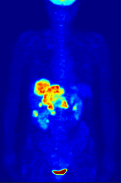 PET scan with radiopharmaceuticals