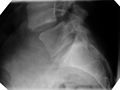 X-ray picture of a grade 1 isthmic spondylolisthesis at L4-5