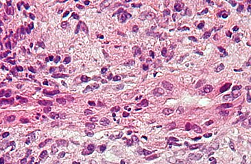 Primary biliary cirrhosis