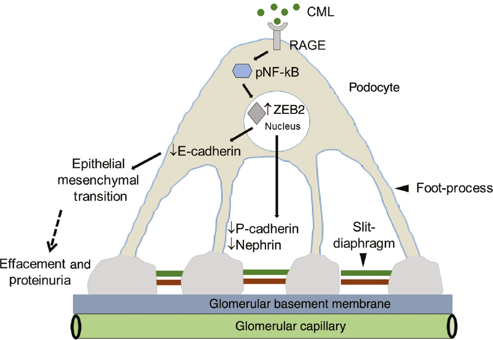 Figure 4: The mechanism by which CML induces podocyte injury and proteinuria.CML, via RAGE, induces NF-κB activation, which in turn stimulates ZEB2 expression. Elevated ZEB2 expression orchestrates podocyte damage by two different ways: (1) ZEB2 transcriptionally suppresses E-cadherin expression by which podocytes may undergo epithelial-mesenchymal transition and detach from the basement membrane, which manifests in decreased podocyte count per glomeruli. (2) ZEB2 also suppresses P-cadherin expression, which is localized to slit-diaphragm (SD) protein. Reduced P-cadherin expression ensues in compromised function of SD. CML also suppresses nephrin, another key protein of SD by an unknown mechanism. Together, the loss of E- and P-cadherin and nephrin manifest in decreased podocyte count and proteinuria.