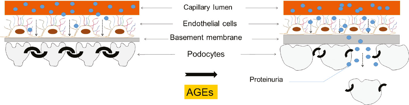 Figure 5: Illustration of the comprehensive effect of AGEs on the glomerular architecture.AGEs induce thickening of the glomerular basement membrane, hypertrophy of podocytes and podocyte epithelial-mesenchymal transition. These events account for the altered structure of the glomerular filtration barrier and reduced podocyte count that ultimately manifest in proteinuria.