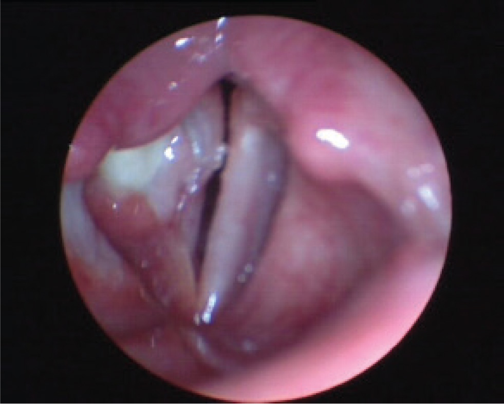 Figure 1 Videostroboscopy before the surgery: granuloma on 2nd and 3rd thirds of the right vocal cord.