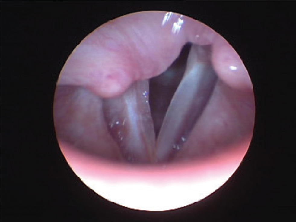 Figure 3 Videostroboscopy after the surgery: normal vocal cord movement, no pathologic masses seen on the right vocal cord.