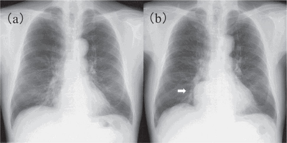 Figure 1 Chest radiography findings.
(a)Chest radiography showed no abnormal shadow.(b)Four years later, a large mass was observed in the right inferior mediastinum (arrow).