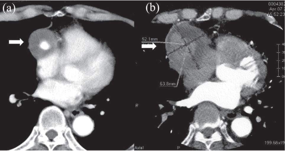 Figure 2 Vein graft aneurysm progression over 4 years.Chest computed tomography showed a small vein aneurysm near the proximal anastomoses (a) and another large aneurysm around distal anastomoses (b, arrows).