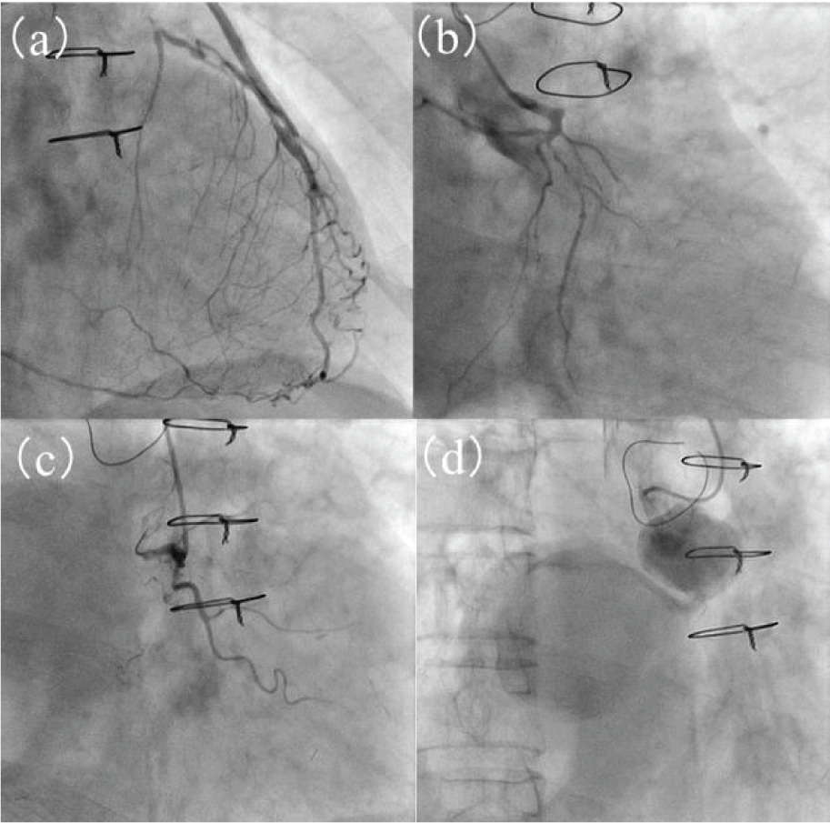 Figure 3 Coronary angiography.(a, b, c) Coronary angiography was performed at the presentation of acute coronary syndrome, revealing that the proximal left anterior descending artery was totally occluded and the left circumflex artery and right carotid artery (RCA) were severely stenosed. (d) Small and large graft aneurysms were visible in the saphenous vein graft of the RCA.