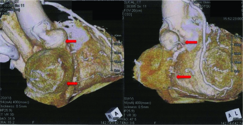 Figure 4 ein graft aneurysm on admission in 3D computed tomography (volume rendering image).Saphenous vein graft aneurysms with diameters of 27 mm and 64 mm, respectively, were found from the head side position in front of the right atrium (red arrows).