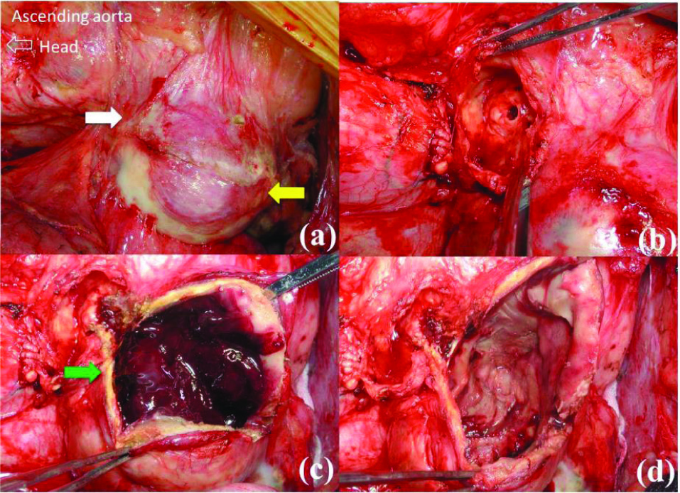 Figure 5 Aneurysm resection.
(a)Proximal small vein aneurysm near the proximal anastomosis (white arrow) and large aneurysm anterior to the right atrium (yellow arrow).(b)Lumen within the incised proximal aneurysm.(c)A large amount of fresh thrombi in the distal aneurysm (green arrow).(d)Luminal cavity within the distal aneurysm after thrombectomy.