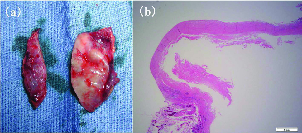 Figure 6 Resected vein graft aneurysm (a) and its microscopic findings (b)The wall thickness of resected vein graft aneurysm was thinner than the healthy segment. Normal three-layer structure was observed microscopically in the enlarged segment of the resected vein graft aneurysm (hematoxylin-eosin stain).