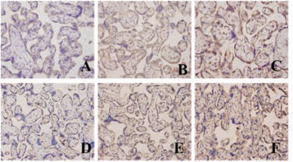 Figure 3 The protein of LXRa and SREBP-1c expression in different tissue (A: LXRa protein expression in placenta of a normal pregnancy; B: LXRa protein expression in a mild PE placenta; C: LXRa protein expression in a severe PE placenta; D: SREBP-1c protein expression in placenta of a normal pregnancy; E: SREBP-1c protein expression in a mild PE placenta; F: REBP-1c protein expression in a severe PE placenta)