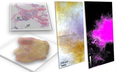 Freshly dissected tissue (lower left) and its pathology-prepared slide with identified tumor regions by a pathologist (upper left), and a pseudo-color image of hyperspectral dark-field microscopy (HSDFM) data cube (middle) region marked on the tissue images on the left.