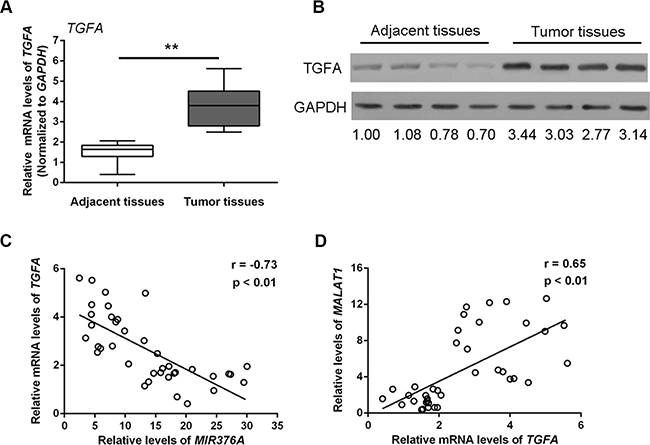 Upregulation of TGFA expression in osteosarcoma tissues and cells and its correlation with MIR376A and MALAT1.