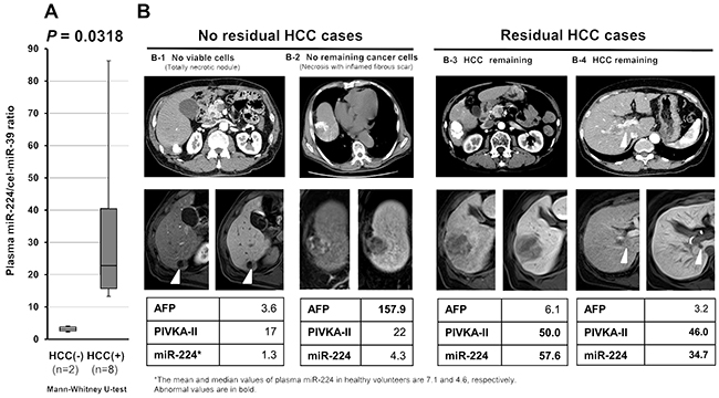 Post-treatment plasma miR-224 level as a sensitive indicator of residual tumor during HCC treatment.