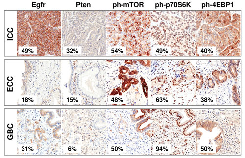 Immunohistochemical profiles of Egfr and mTOR pathway in cholangiocarcinomas.