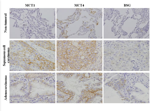 Immunohistochemical expression of the monocarboxylate transporters, MCT1 and MCT4, and their chaperone protein BSG in lung cancer samples.