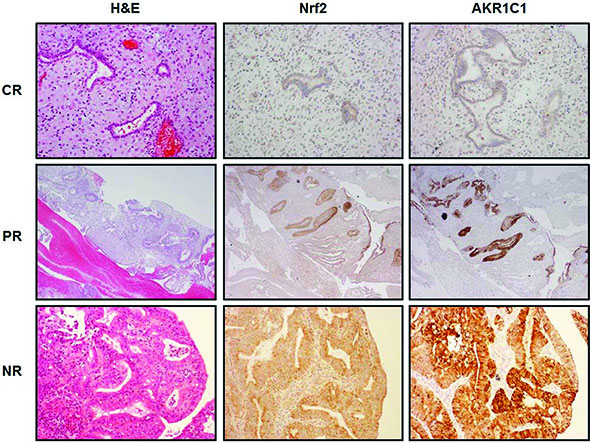 Nrf2 and AKR1C1 expression in progestin treated endometrial samples.