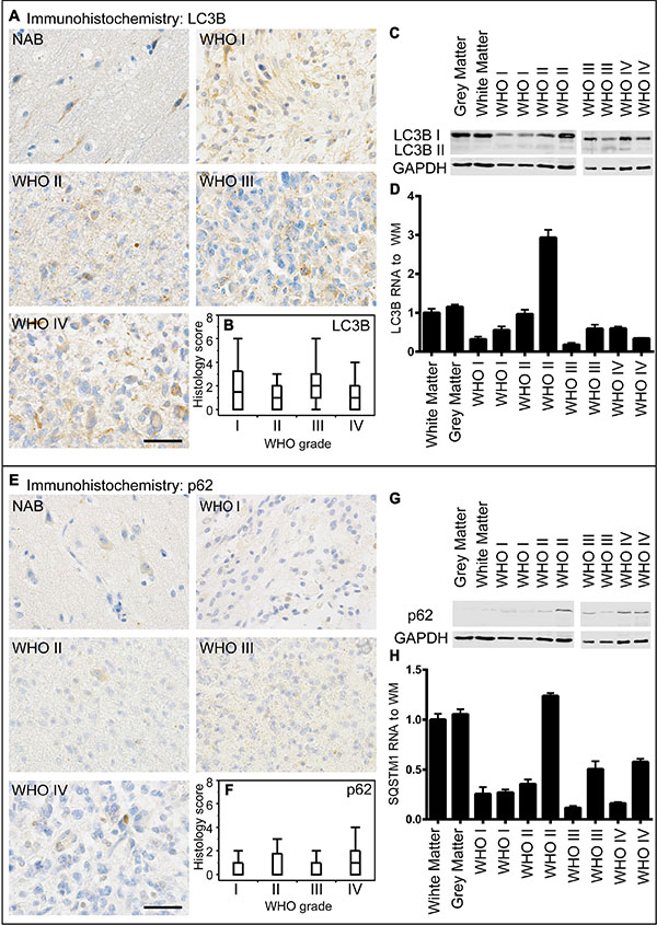 LC3B and p62 expression in human astrocytomas.