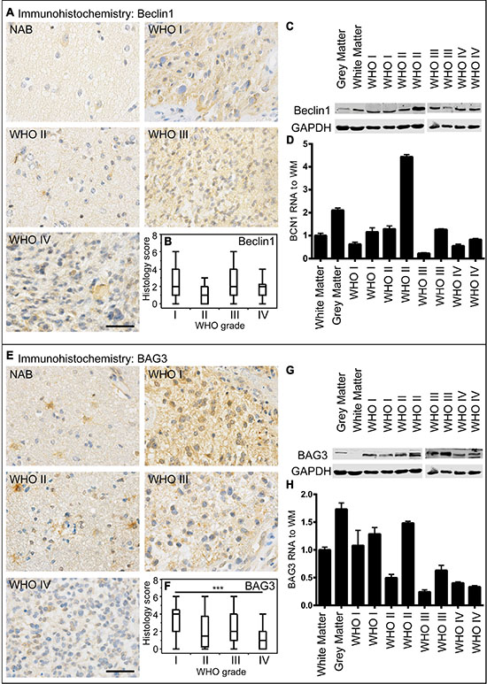 Beclin1 and BAG3 expression in human astrocytomas.