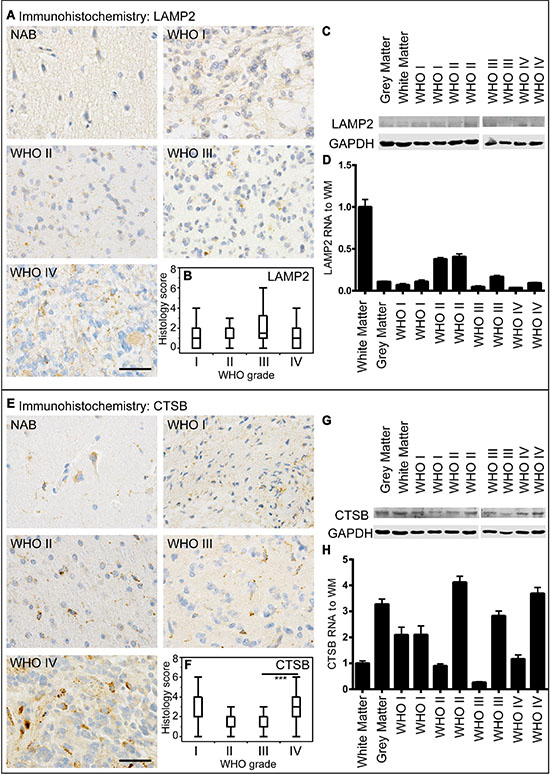 LAMP2 and CTSB expression in human astrocytomas.