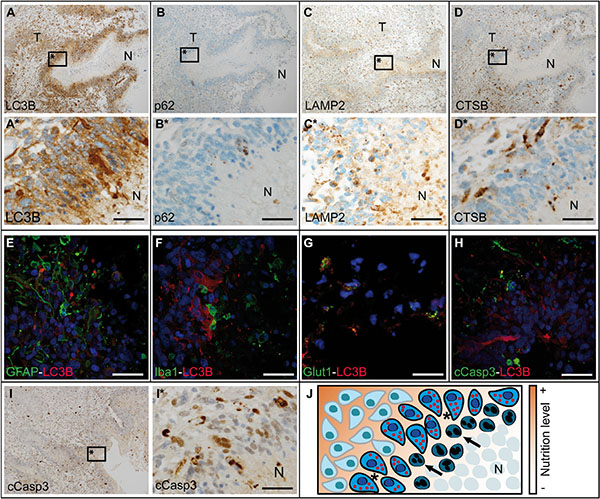 Autophago-lysosomal proteins are upregulated in close vicinity to necrotic foci in glioblastoma.