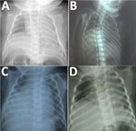 Thumbnail of Chest radiographs of infants with congenital Zika syndrome, demonstrating elevation of the right hemidiaphragm. Panels A–D represent patients 1–4, respectively. In each instance, only the right hemidiaphragm was noticeably elevated. All patients also had arthrogryposis (including talipes equinovarus) and died from complications related to progressive respiratory failure.